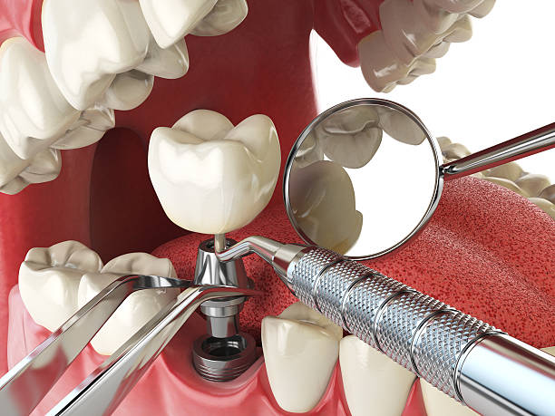 Best Emergency Tooth Extraction in Auberry, CA